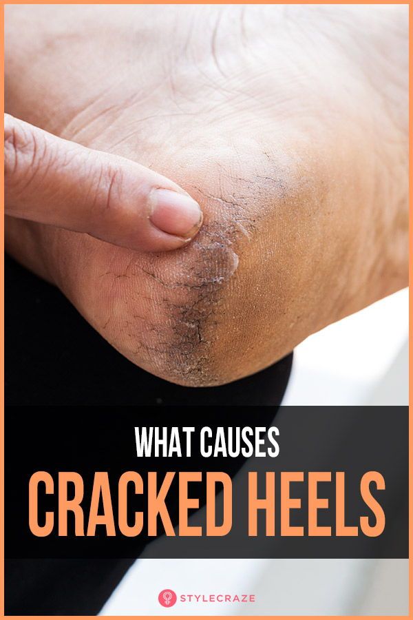 What Causes Cracked Heels? #trending #trends #trendingnow Soften Heels Diy, Soft Heels How To Get, Soft Heels Remedies, How To Get Rid Of Rough Heels, Rough Feet Remedy Heels, Healing Cracked Heels, Heel Cracks Remedies, How To Get Rid Of Cracked Heels, Dry Heels How To Get Rid Of