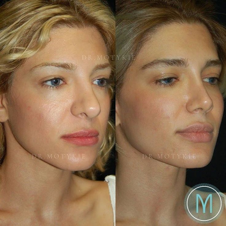 Revision Rhinoplasty, Nose Plastic Surgery, Nose Surgery Rhinoplasty, Nose Job Inspo, Dream Nose, Korean Plastic Surgery, Rhinoplasty Nose Jobs, Nose Reshaping, Rhinoplasty Before And After