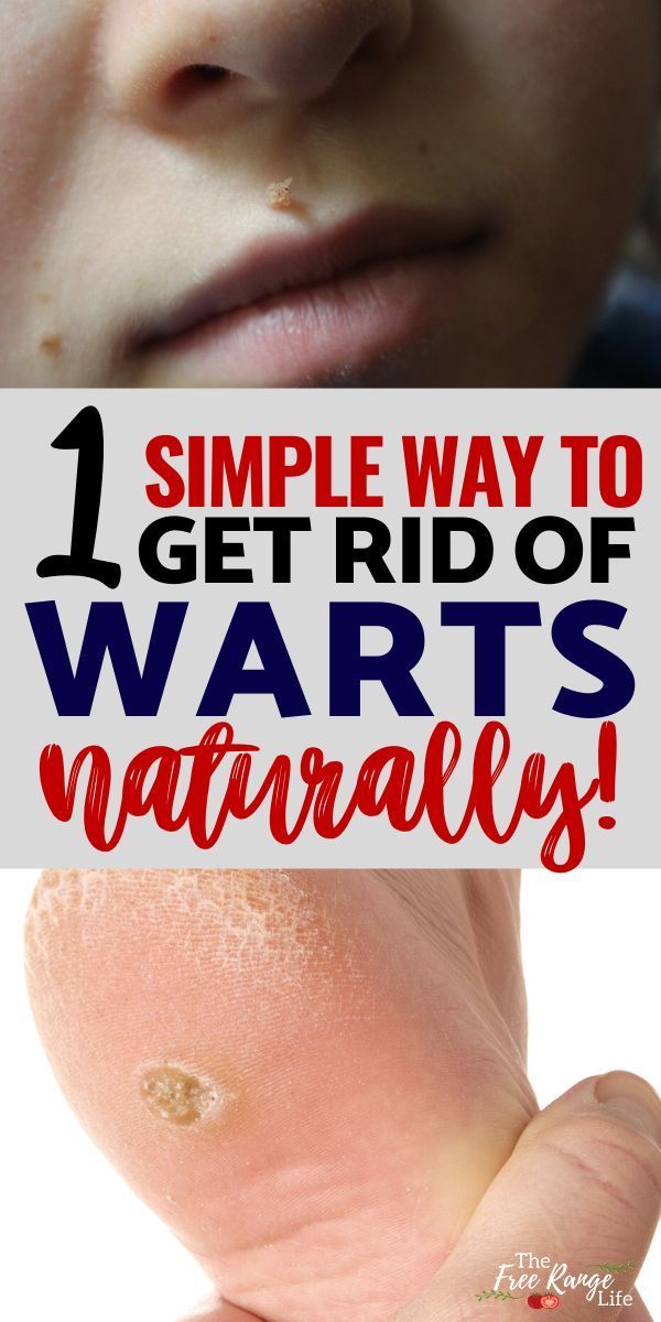 Got a wart on your face, hands or feet? Try this simple trick to get rid of warts fast and naturally! Safe wart removal for kids and safe for use on warts on the face. If you are looking for a safe, effective, natural way to get rid of warts this is it! #NaturalRemedies #Frugallife #homesteading #wartremoval #DIY Planters Wart, Warts On Hands, Warts On Face, Warts Remedy, Get Rid Of Warts, Cold Sores Remedies, Natural Cold Remedies, Natural Cough Remedies, Cold Home Remedies