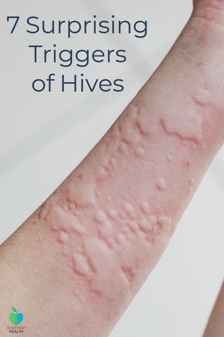 Did you know a #workout can trigger #hives? Allergy Hives, Hives Remedies, Chronic Hives, Home Remedy For Cough, Everyday Health, Natural Cough Remedies, Cough Remedies, Daily Health Tips, Oral Health Care