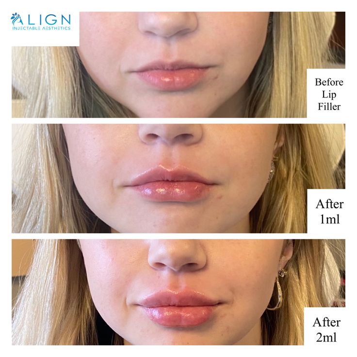 Half Syringe Lip Filler Before And After, 1 Syringe Lip Filler, Lip Filler One Syringe, 2 Syringes Of Lip Filler, Lip Filler 1 Syringe, Lip Filler 2 Syringe, 1ml Lip Filler, Face Plastic Surgery, 1.5 Ml Lip Filler