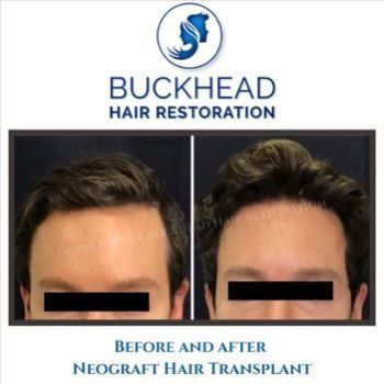 (PRP)Therapy & NeoGraft Hair Restoration at Buckhead Hair Restoration Savannah Prp Therapy, Hair Transplant Procedure, Platelet Rich Plasma, Types Of Hair, Hair Replacement, Hair Restoration, Hair Transplant, Med Spa, Healing Process