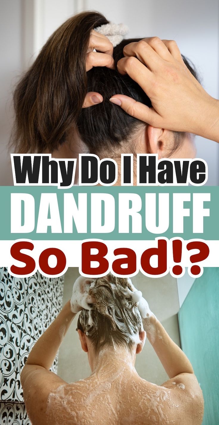 How To Reduce Dandruff, How To Prevent Dandruff, Bad Dandruff, What Causes Dandruff, Best Shampoo For Dandruff, How To Remove Dandruff, Severe Dandruff, Hair Mask For Dandruff, Dandruff Causes