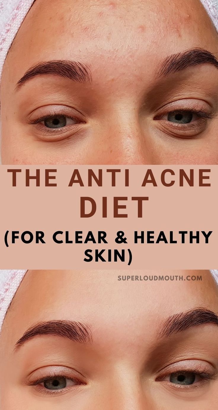 Acne Diet Plan, Anti Acne Diet, Back Acne Remedies, Clear And Glowing Skin, Acne Diet, Forehead Acne, Skin Diet, Clear Healthy Skin, Natural Acne Remedies