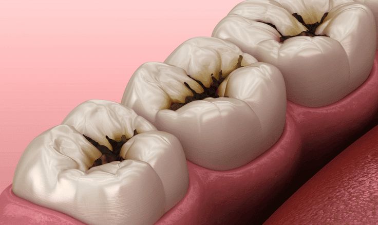 A tooth cavity, or dental caries or decay, is a localized area of damage to the tooth’s hard tissues, primarily caused by bacterial activity. When sugars and starches in food interact with bacteria in the mouth, they produce acid that erodes the tooth enamel. Over time, this process leads to the formation of cavities, compromising the tooth’s structure. Tooth Caries, Dental Pictures, Dental Advertising, Dental Images, Tooth Cavity, Laser Dentistry, Dental Videos, Dental Health Care, Dental Cavities