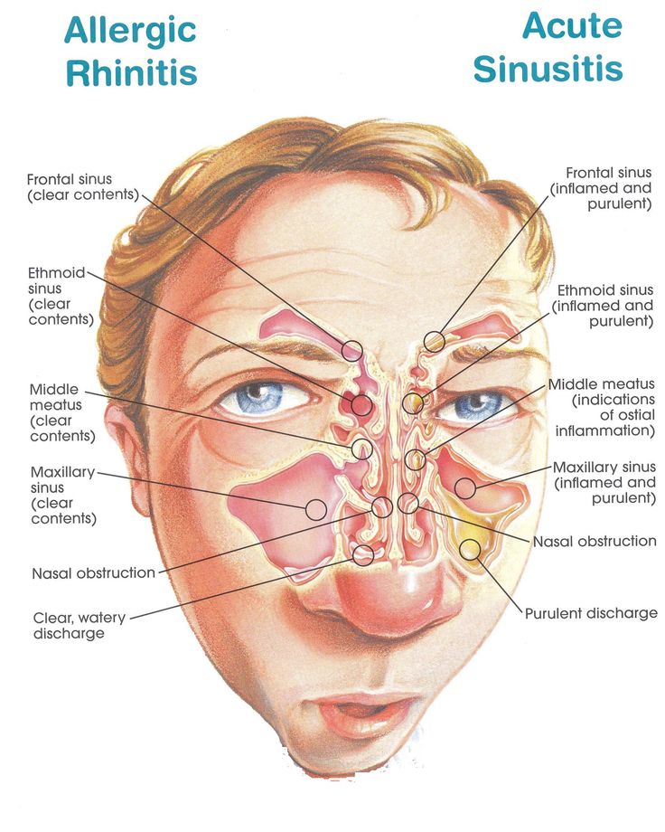 an illustrated diagram of the facial structure of a man's head with allergic rhinoplasts