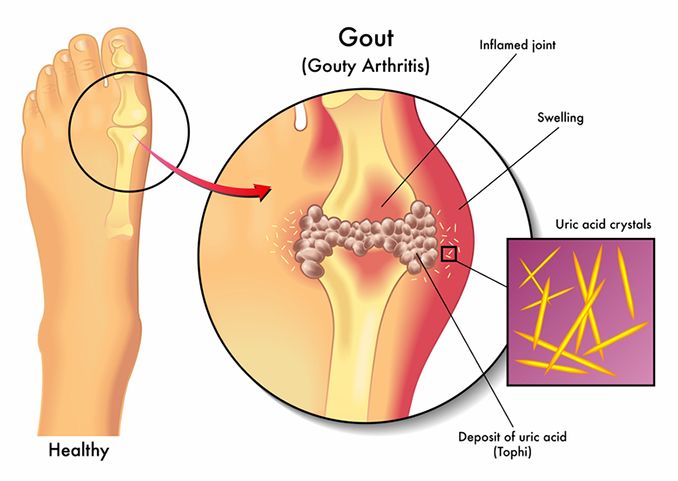 If you’ve ever woken up with severe pain in the base of your big toe, instep, or ankle, you may have had a bout of gout. In foot as well as hand and wrist areas, gout is unpleasant but can be short-lived if treated correctly. Kwas Moczowy, Uric Acid, Natural Drinks, Joints Pain Relief, Acupuncture Points, Doterra, Pain Relief, Home Remedies, Just In Case