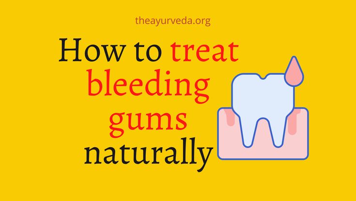 Gum bleeding that occurs while brushing or flossing could be under the assumption that it is common. But it is not. Treat bleeding gums naturally... Inflamed Gums Remedies, Swollen Gums Remedy, Bad Breath Remedy, Swollen Gum, Full Body Workout Routine, Receding Gums, Dental Tools, Healthy Beauty, Natural Health Remedies