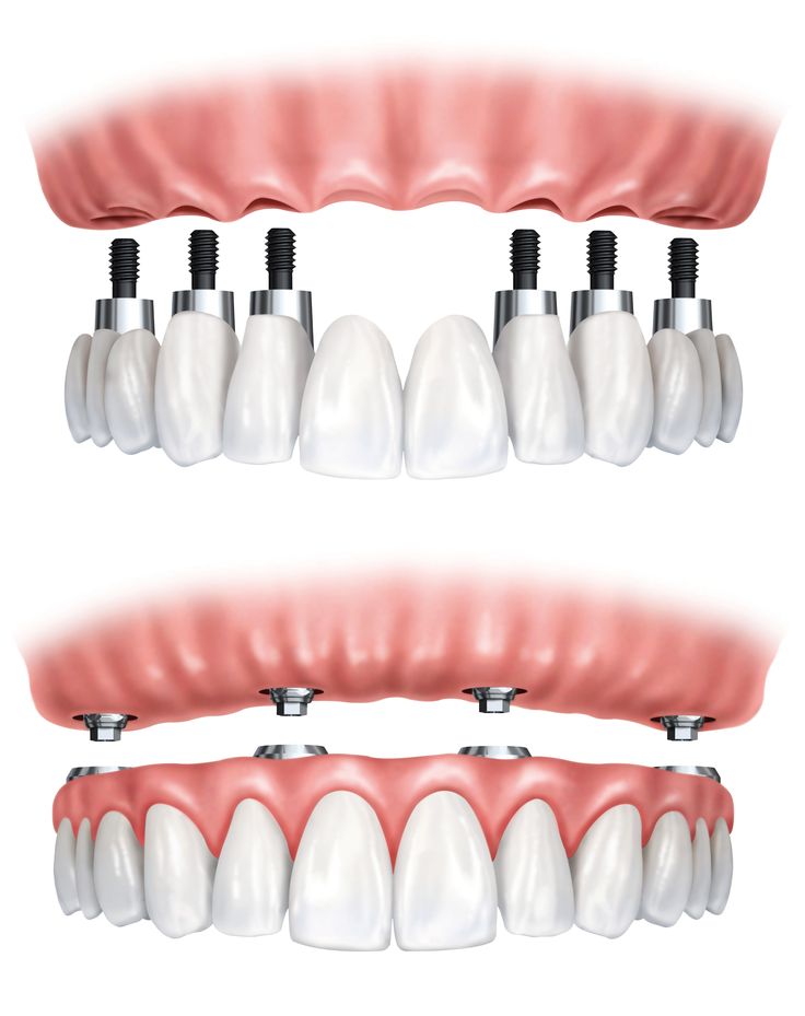 Dental Images, Dental Implant Procedure, Denture Implants, Best Dental Implants, Dental Implant Surgery, Dental Implants Cost, Implant Dentistry, Teeth Implants, Dental Bridge