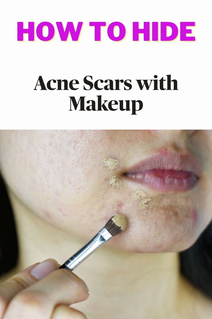 Scar On Forehead, Cover Up Pimples, Covering Acne, Acne Scaring, Cover Wrinkles, Facial Scars, Cold Sore Remedies, Pimples Under The Skin, Makeup Coverage