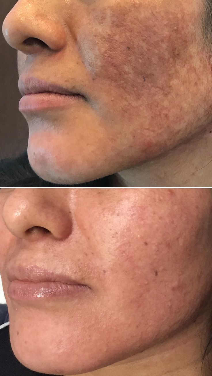 Facials, Chemical Peels and our Obagi NuDerm Transformation Kit with Tretinoin produced these amazing results! This patient had post-inflammatory hyper-pigmentation and was treated over a few months! #ChemicalPeels #Beauty #Obagi #ContourDermatology #ContourDermatologySpa Hyper Pigmentation On Face, Mesotherapy Before And After, Eye Bag Surgery, Laser & Ipl Hair Removal Devices, Hyper Pigmentation, Facial Anatomy, Facial Fillers, Hair Removal Devices, Chemical Peels