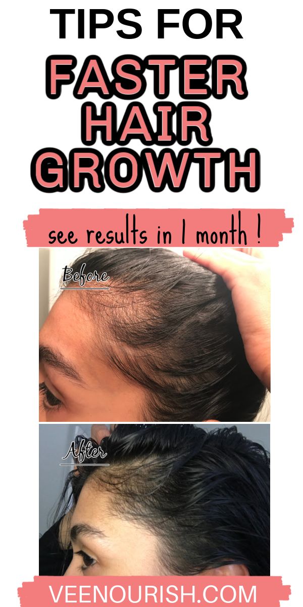 Hair Regrowth Grow Baby Hair, Hair Regrowth Remedies, Hair Regrowth Women, Postpartum Tips, Postpartum Hair, Get Thicker Hair, Overnight Hairstyles, Hair Growth Secrets, Hair Regrowth Treatments