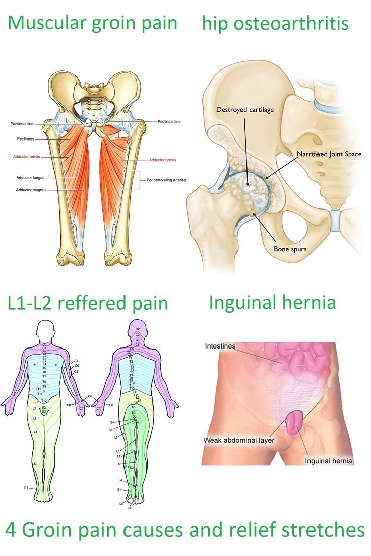 These are the 4 most common causes for groin pain. Groin pain caused by an inguinal hernia often needs surgery to recover, but the other causes for groin pain can be relieved with stretches and strength exercises for you lower back and hip. Check out our website for the treatment of groin pain. Muscles, Human