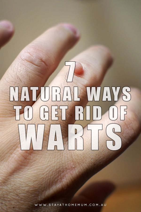 Different Types Of Warts, Types Of Warts, Warts On Hands, Home Remedies For Warts, Warts Remedy, Get Rid Of Warts, Home Remedy For Cough, Cold Sores Remedies, Natural Sleep Remedies