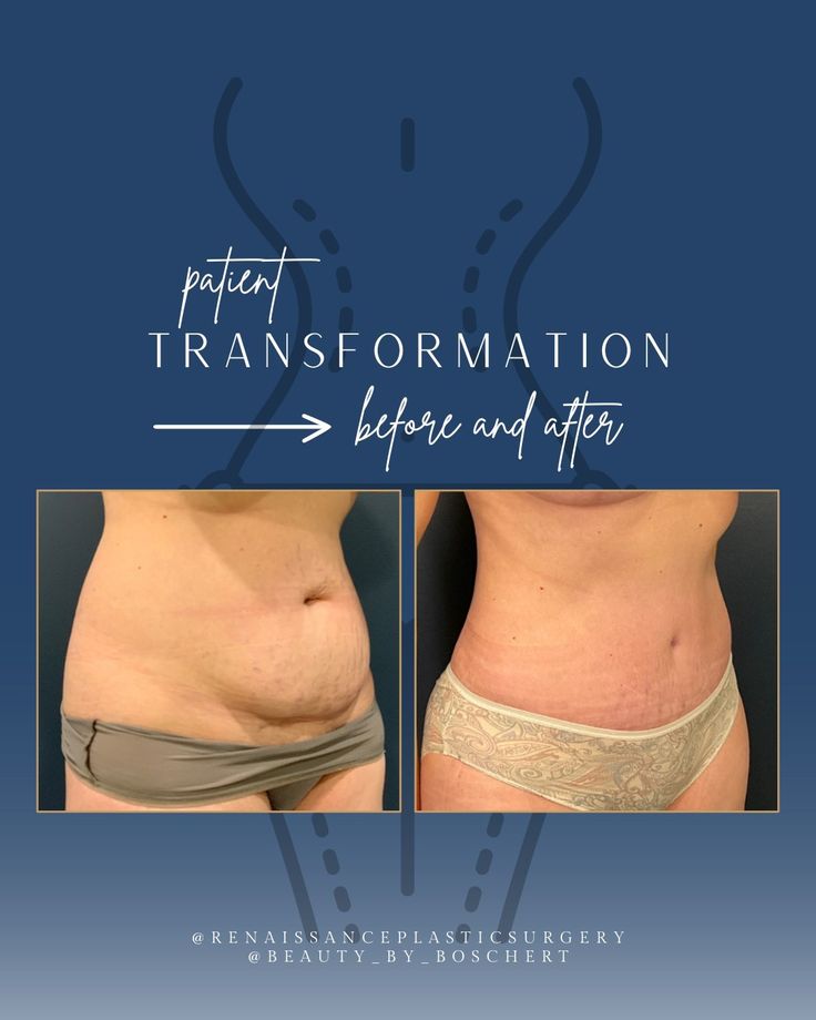 Ready to get that pre-baby body back? Dr @beauty_by_boschert was able to help our patient do just that with a Mommy Makeover that included abdominoplasty, muscle repair, liposuction and a breast reduction. We're here to help you reach your aesthetic goals for 2024. Interested in learning more? Schedule a consultation today! 📞(636) 896-0600 🌎 https://www.rpsplasticsurgery.com/ 📍St. Peters, MO #mommymakeover #tummytuck #breastaugmemtation #plasticsurgery #mombod #stl #stlouis Muscle Repair, Mom Bod, St Peters, Mommy Makeover, Breast Reduction, Medical Spa, Tummy Tucks, Baby Body, Media Content