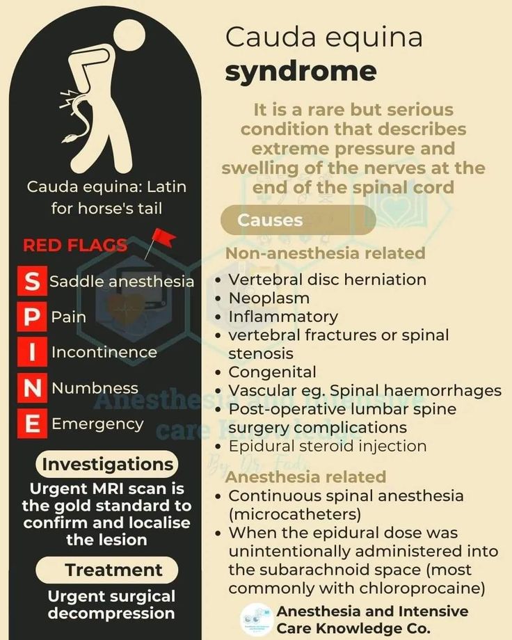 Spinal Fusion Surgery, Cauda Equina, Spinal Fusion, Disk Herniation, Mri Scan, Medical School Essentials, Ehlers Danlos, Medical Anatomy, Ehlers Danlos Syndrome