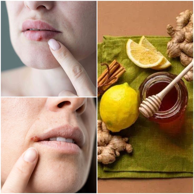 Home Remedies for Cold Sores Scab Healing, Home Remedies For Cold, Sore Lips, Healing Tips, Cold Sores, Cold Sores Remedies, Natural Cold Remedies, Cold Home Remedies, Cold Sore