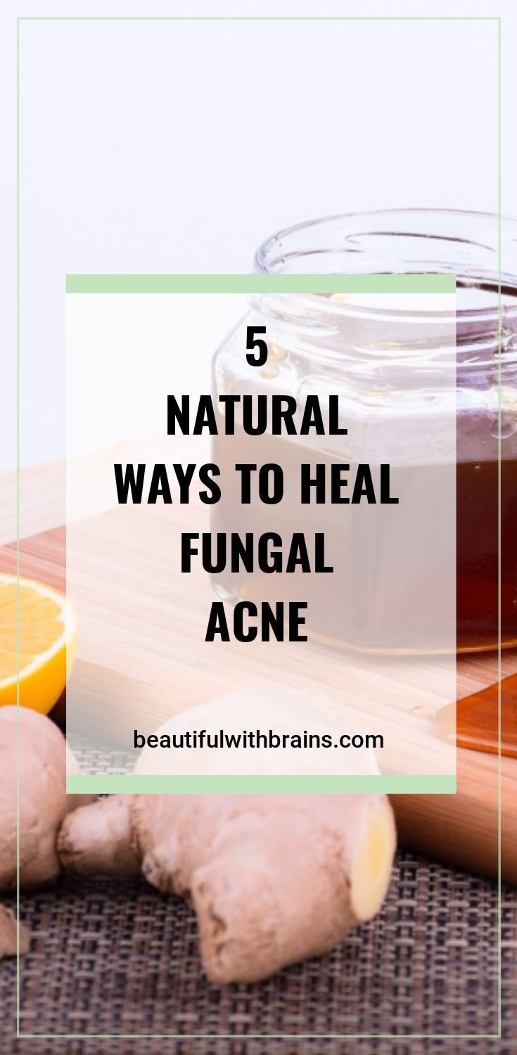 Fungal Acne, Forehead Acne, Ways To Heal, Acne Help, Natural Acne Remedies, Natural Acne, Acne Free, Acne Remedies, How To Get Rid Of Acne