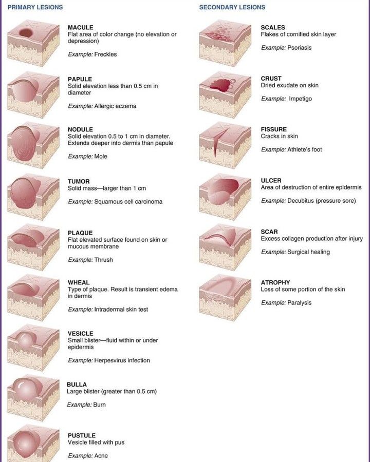 Medical Case Presentation 在 Instagram 上发布：“🔹️Different types of skin lesions . 🔸️Types of primary skin lesions  Birthmarks are primary skin lesions, as are moles, rashes, and acne.…” Cosmetology State Board Exam, Cosmetology State Board, Skin Lesions, Esthetician Inspiration, Nurse Study, Skin Anatomy, Medical Esthetician, Esthetician School, Esthetician Marketing