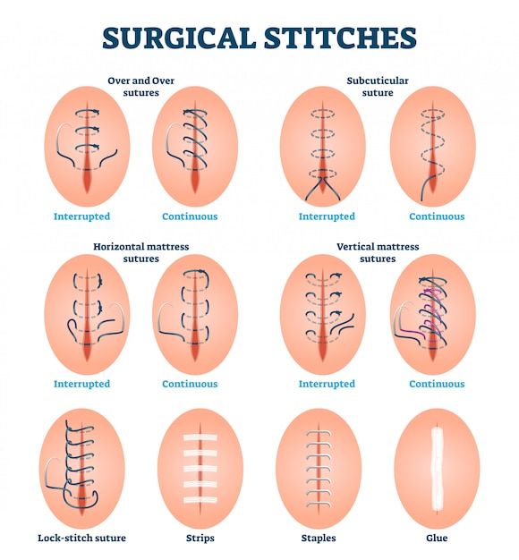 the surgical stitches chart shows different types of surgery and how they are used to treat them