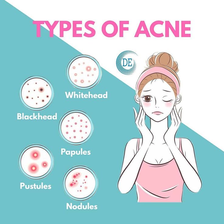 Jenis Jerawat, Skincare Blogger, Types Of Acne, Skincare Review, Luxury Skincare, Skin Care Regimen, Skin Care Tips, Skin Care Routine, Skin Care