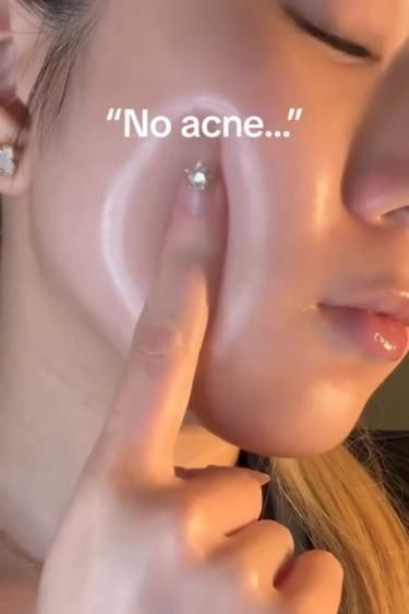 acne prone skin sensitive skincare routine Clyndamiacin For Acne, Best Products For Acne Prone Skin, What Does My Acne Mean, Skincare For Sensitive Acne Prone Skin, Skin Care Solutions Acne, Pimple Patches Aesthetic, Products For Pimples, Pimples Skin Care, Skincare Acne Prone Skin