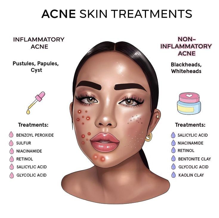 Best Skincare Products for Hyperpigmentation and Dark Spots Skin Treatments For Dark Spots Beauty Products, How To Clear Acne, Skincare Tips For Acne, Skincare Products For Hyperpigmentation, Products For Hyperpigmentation, Acne Tips, Mild Acne, Dry Skincare, Instagram Skincare