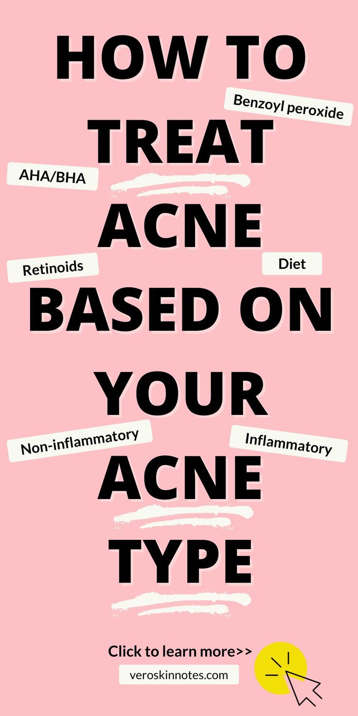 How to treat acne? There is no one-size-fit-all solution to treating acne. To treat acne you need to first understand your acne type and the causes of acne. Only then can you aim your acne treatment based on your personal acne issue. Learn more about acne treatment including changing your diet, chemical (BHA/AHA) and mechanical exfoliation, retinoids, benzoyl peroxide, antibiotics and more! Nodule Acne, Face Mapping Acne, Acne Diet, Forehead Acne, Lotion For Oily Skin, Bad Acne, Oily Skin Acne, Acne Skincare Routine, Natural Acne Remedies