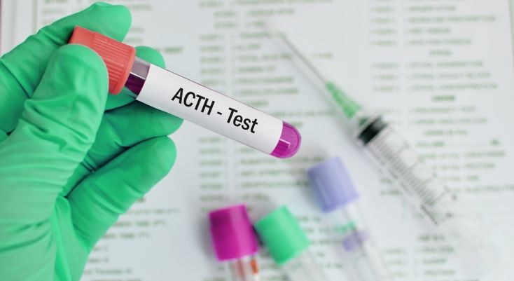 Why is this test performed?

This hormone test is evaluated in different conditions, such as Adrenal insufficiency, in Acromegaly and Cushing Syndrome.
In Addison's disease, the level of Adrenocorticotropic hormone (ACTH) is noted more than 1000 pg/ml.
In Adrenal carcinoma, Adenoma, and Adrenocortical insufficiency, the level of Adrenocorticotropic hormone (ACTH) decreases.

Collection of Sample
For the estimation of Adrenocorticotropic hormone (ACTH), patient’s plasma is needed. Blood is c Low Ferritin, Thyroid Test, Cholesterol Test, Medical Journal, Penyakit Jantung, دورة شهرية, Hashimotos Disease, Allergy Testing, Thyroid Function