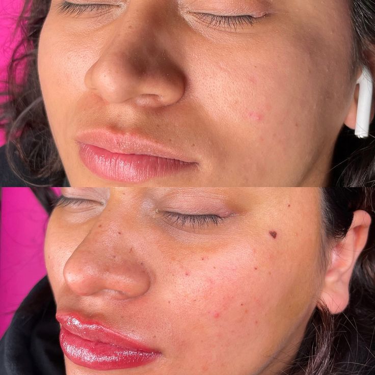 a woman with freckles on her face is shown before and after acne treatment