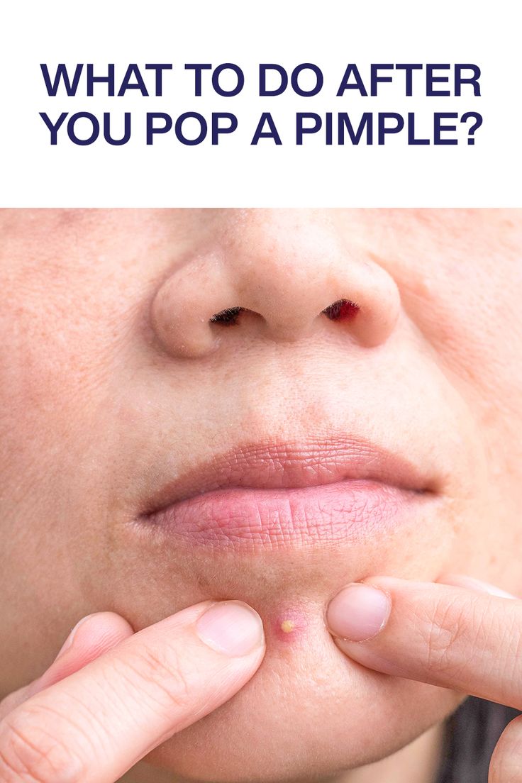 Wondering how to heal a popped pimple? Look no further, because here are some easy tips from board certified dermatologists to get rid of the acne and skin damage. How To Get Rid Of A Pimple Instantly, Pimple Patches Before And After, Acne Popping, Quickest Way To Get Rid Of Pimples, How To Heal A Popped Pimple, How To Heal Popped Pimples Fast, Instant Remedy For Pimples, Why Am I Getting Pimples, Neck Pimples