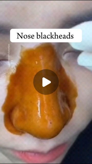 HomeBeautyHack on Instagram: "Nose Blackheads/Whiteheads Gai removal in 1 one day with this easy DIY mask| if you have lots of blackheads and whiteheads issue on your nose and cheek area so try this.
.
.
Repeat every week..
.
.
Follow for more .
.
.
.
.cc👉@beautifulyoutips❤️
#skincare #skincareroutine #blackheads #whiteheads #acne #reels" Black Head Removal Video Nose, Blackheads On Cheeks, Nose Blackheads, Blackheads On Face, Blackheads And Whiteheads, Remove Blackheads From Nose, Blackhead Extraction, Face Mask For Blackheads, Blackhead Remedies