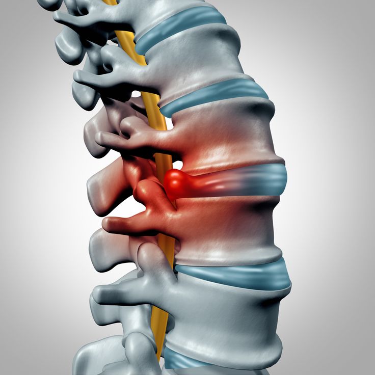 Lumbar Disc, Intervertebral Disc, Disk Herniation, Bulging Disc, Nerve Health, Sciatic Nerve Pain, Sciatica Pain, Sciatic Nerve, Chiropractic Care