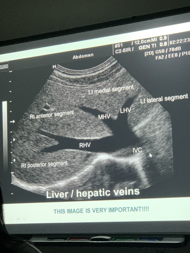 an x - ray image of a person's chest on a computer screen with the words liver / hepatic veins