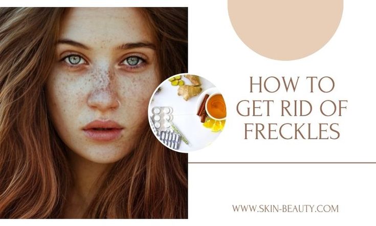 How to Get Rid of Freckles  	Freckles are small, flat, brown spots on the skin caused by an accumulation of melanin, the pigment responsible for skin color. They usually occur as a result of sun exposure and are more common in individuals with fair and light skin. While freckles are harmless, many people seek ways to reduce or remove them for cosmetic reasons. Getting Rid Of Freckles, Fresh Aloe Vera Gel, Fractional Laser, Sun Damaged Skin, Chemical Peel, Sun Exposure, Glowing Complexion, Broad Spectrum Sunscreen, Brown Spots