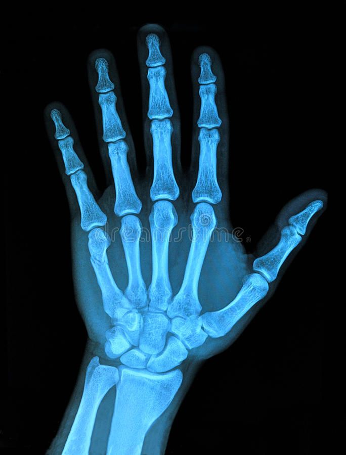 an x - ray image of the hand and wrist bones in blue light on a black background