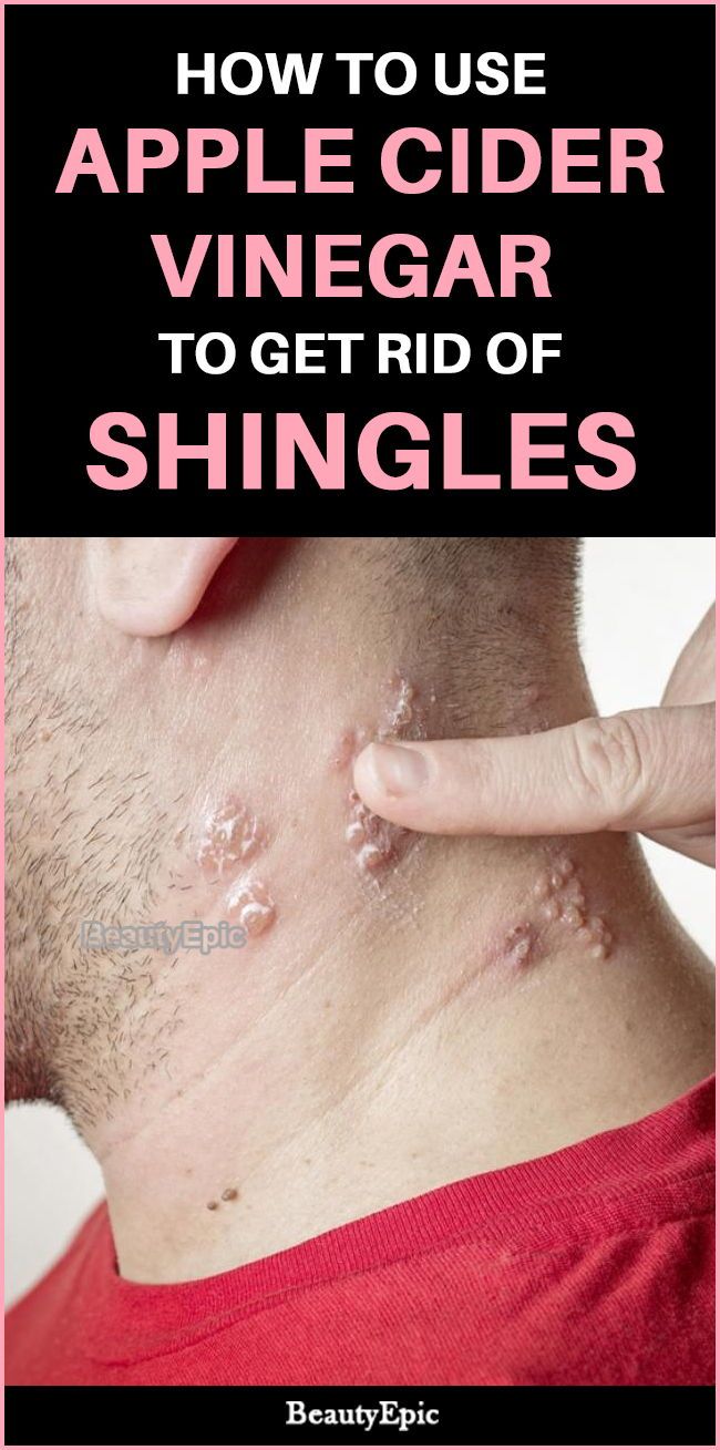 Avocado Seed Benefits, Oils For Shingles, Shingles Remedies, Essential Oils For Shingles, Shingles Relief, Shingles Rash, Seed Benefits, Coldsore Remedies Quick, Apple Cider Vinegar Uses