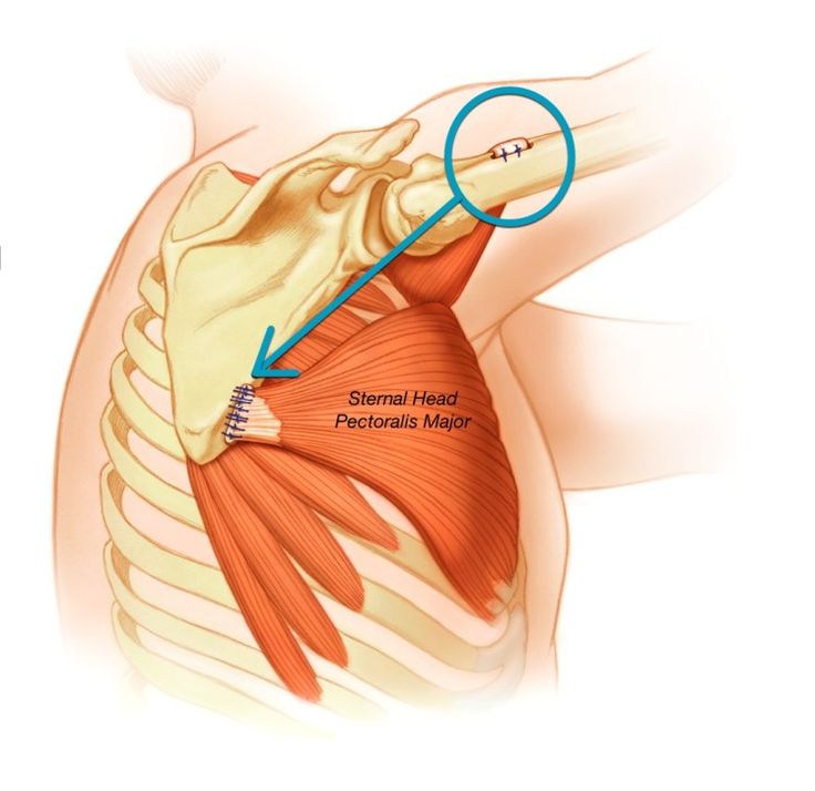 an image of the shoulder muscles with arrows pointing up to it's left side