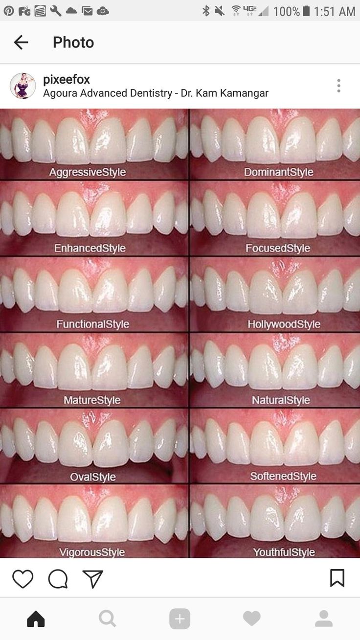 Cosmetic Dentistry Procedures, Veneers Teeth, Beautiful Teeth, Perfect Teeth, Porcelain Veneers, Teeth Shape, Dental Veneers, Dental Art, Smile Teeth