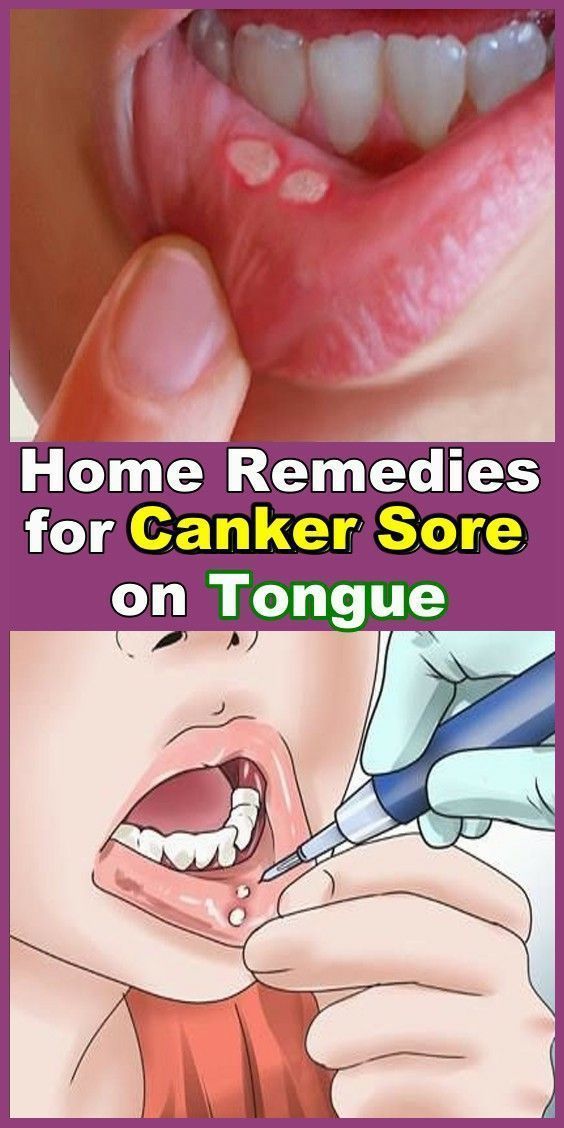 Home Remedies for Canker Sores on Tongue | My-FavThings | Bloglovin’ Sores On Tongue, Canker Sore On Tongue, Canker Sore Causes, Canker Sore Remedy, Tongue Sores, Canker Sore, Receding Gums, Oral Care Routine, Oral Health Care