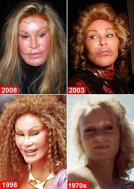 #plasticsurgery #plasticsurgerygonewrong #beforeafter #celebritiesbeforeafter #hollywoodstars #bignosesurgery #surgery #facesurgery #vlinesurgery #koreanplasticsurgery #kpopplasticsurgery #nosejob #jawreductionsurgery #eyesurgery #cheekfillers #rhinoplasty #facelift #plasticsurgeryfails #expensiveplasticsurgery Overbite Before And After, Scariest Picture, Botched Plastic Surgery, Bad Celebrity Plastic Surgery, Plastic Surgery Fails, Bad Plastic Surgeries, Plastic Surgery Fail, Plastic Surgery Gone Wrong, Surgery Doctor