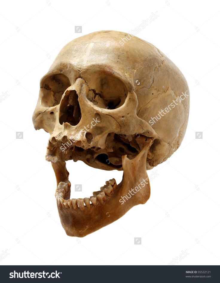 a human skull with the lower jaw missing from it's left side, on a white