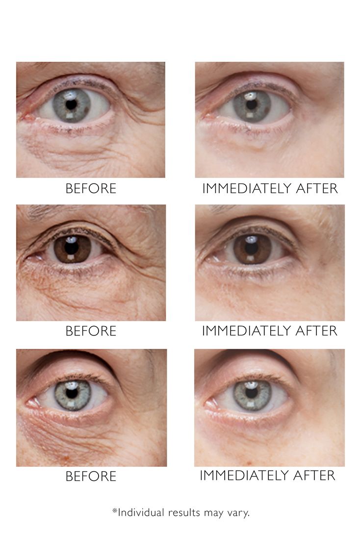 What it is: A treatment that helps tighten, firm and smooth the eye area to instantly minimize the appearance of crow's feet, fine lines and deep wrinkles.What it does: It helps diminish undereye puffiness, too. It's formulated with Firm-A-Tite, a trio of instant skin tighteners to lift, firm and tighten appearance; Eyeliss, a trio of peptides to visibly diminish under-eye puffiness by helping improve circulation; and Eye Regener, which targets bags under eyes by helping diminish excess fluids a Baking Soda Under Eyes, Mid Face Lift, Bags Under Eyes, Under Eye Puffiness, Skin Care Wrinkles, Diy Body Care, Under Eyes, Peter Thomas Roth, Eye Wrinkle