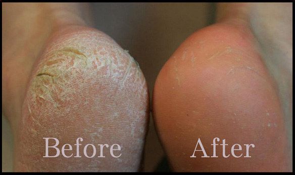 If you've got tons of dry, scaly skin on the bottoms of your feet, try a Baby Foot exfoliating mask. Dry Cracked Heels, Scaly Skin, Exfoliating Mask, Foot Soak, Cracked Heels, Callus Removal, Skin Problems, Dead Skin, Home Remedies