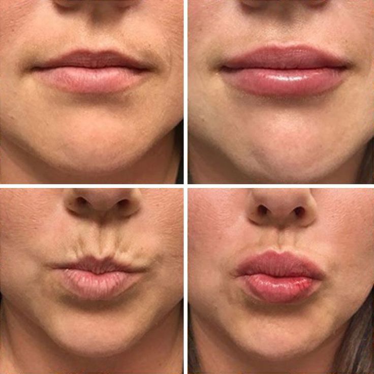 Before-and-After-Lip-filler Juvederm Before And After, Hyaluronic Acid Fillers, Droopy Eyelids, Droopy Eyes, Listen Carefully, Small Lips, Healthy Lips, Lip Filler, Hydrating Lip Balm