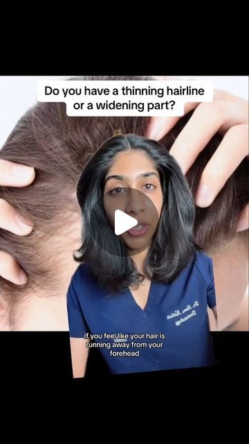 #greenscreen Androgenetic alopecia is a common type of hair loss caused in part by an imbalance of a hormone called DHT. It can present a... | Instagram Balding Women Help, Haircut For Receding Hairline For Women, Different Parts For Hair, How To Fix Thinning Hair, Hair Lossing Tips Natural, Nutrafol Before And After, Androgenic Alopecia In Women, Hairstyles For Balding Woman, Receding Hairline Women