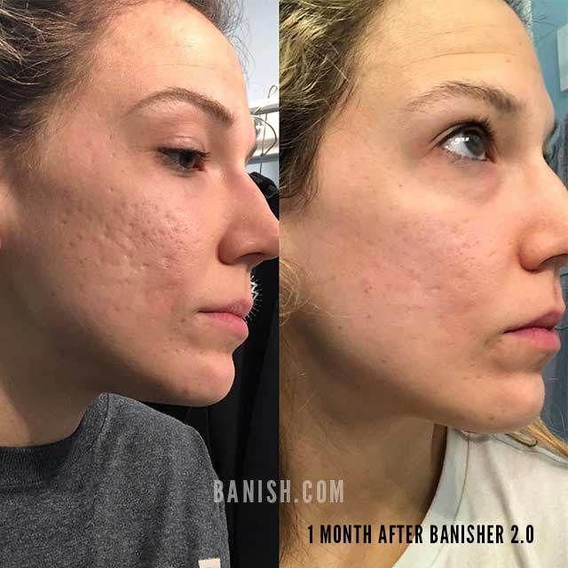 Fade acne scars, fine lines, and dark spots with the Banisher 2.0 Microneedle stamp tool. Microneedling at home made easy, safe, and effective. Hyperpigmentation Mask, Remove Skin Tags Naturally, Bad Acne, Natural Acne Remedies, Acne Scar Removal, Saggy Skin, Get Rid Of Blackheads, Derma Roller, Scar Removal