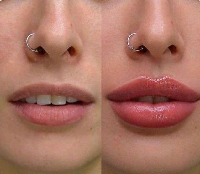 Lips Inspiration, Permanente Make-up, Face Fillers, Botox Lips, Cheek Fillers, Facial Fillers, Facial Contouring, Lip Augmentation, Facial Aesthetics