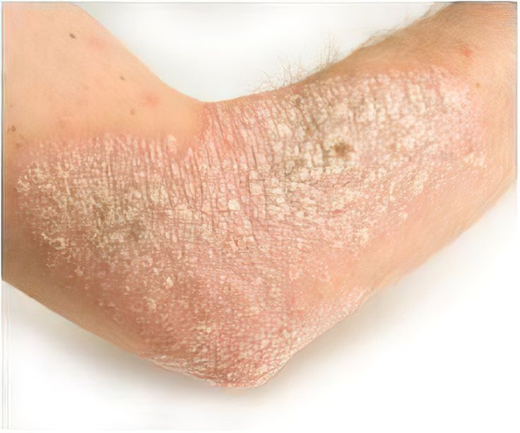 Scientists have discovered a possible culprit behind eczema and allergic skin diseases. Fungal Rash, Bow Legged Correction, Dry Skin Remedies, Skin Condition, Skin Diseases, Whitening Cream, Kombucha, Skin Conditions, Young Living