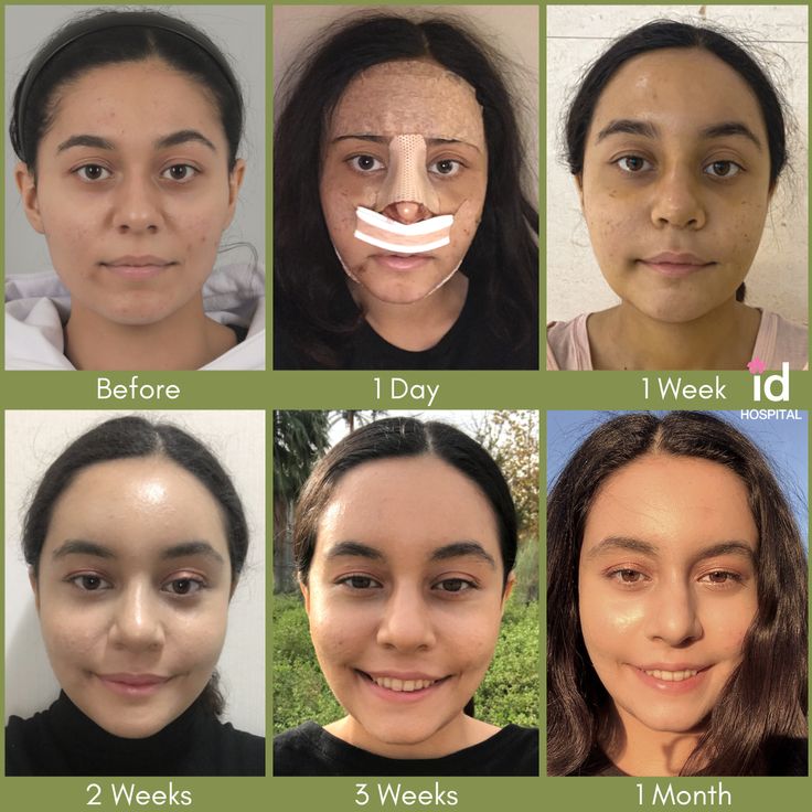 Nardeen was here in December 2020 to get her surgeries at ID Hospital! She had V-line Surgery, Cheekbone Reduction, Rhinoplasty, Full Face fat graft and V-3 Lift. #idhospitalkorea #koreanplasticsurgery #plasticsurgery #plasticsurgerykorea #cosmeticsurgery #seoul #korea #plasticsurgerybeforeandafter #beforeandafter #beforeandaftersurgery #besttransformation #rhinoplasty #nosejob #barbierhinoplasty #fatgraft #facialcontouring #threadlift #vline #vlinesurgery #jawreduction #cheekbonesurgery Reduction Rhinoplasty, Cheekbone Reduction, Kpop Plastic Surgery, Jaw Reduction Surgery, V Line Surgery, Plastic Surgery Korea, Plastic Surgery Fail, Toxic Positivity, Korean Plastic Surgery